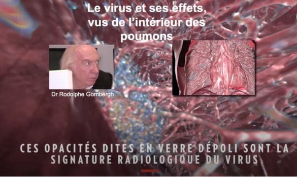 Incroyable vidéo du voyage dans des poumons infectés